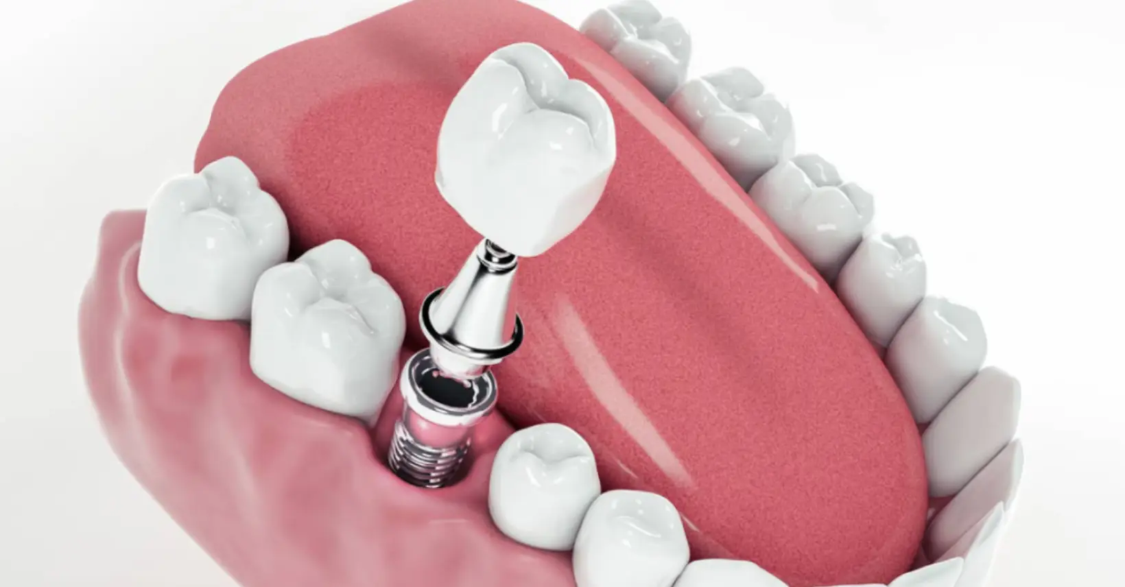Worth the trip? Navigating the World of Dental Tourism