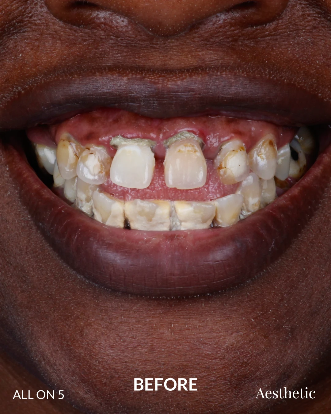 Kenia — Before